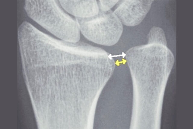 単純X線でDRUJの開大