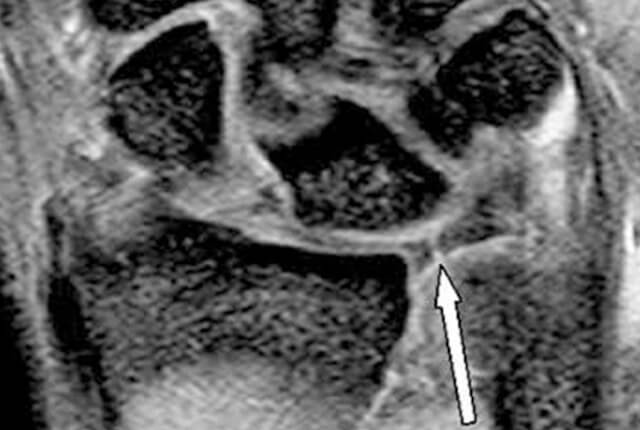 MRIでTFCC損傷所見