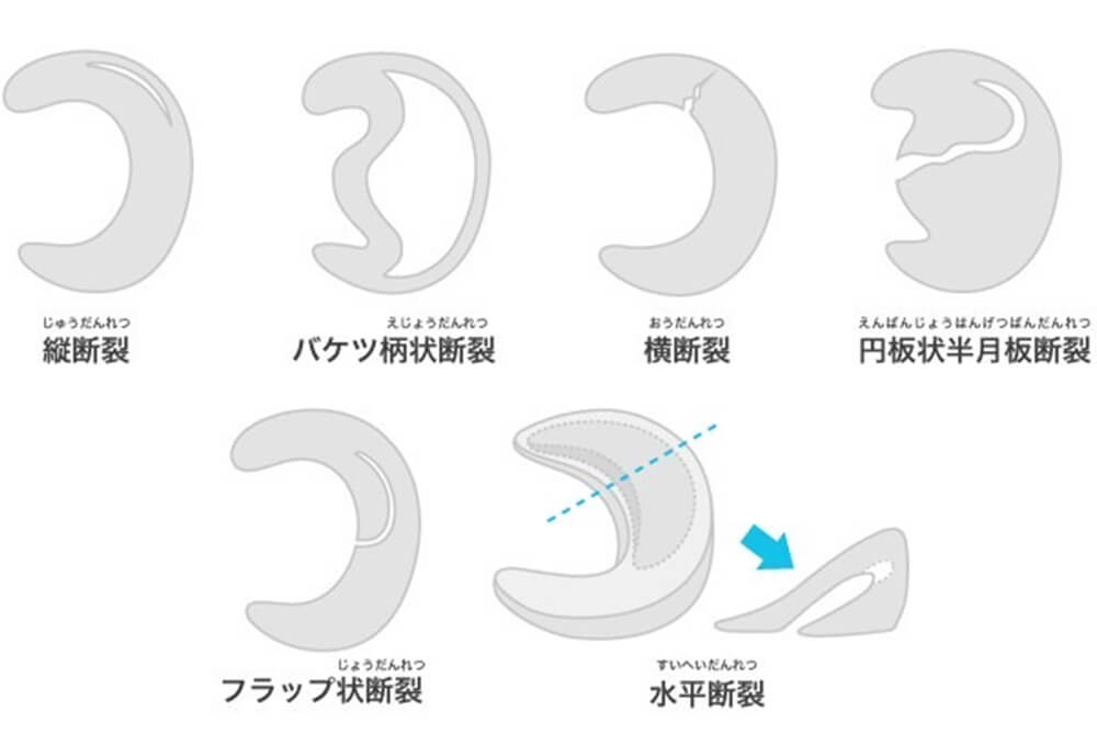 半月板の断裂形態