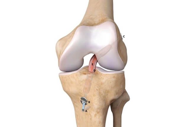 関節鏡視下ACL再建術