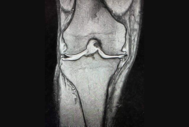 半月板手術の工夫