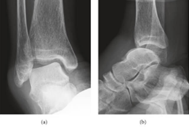ストレスX線撮影