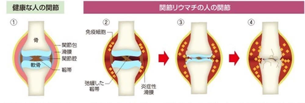 関節リウマチの病因・病態