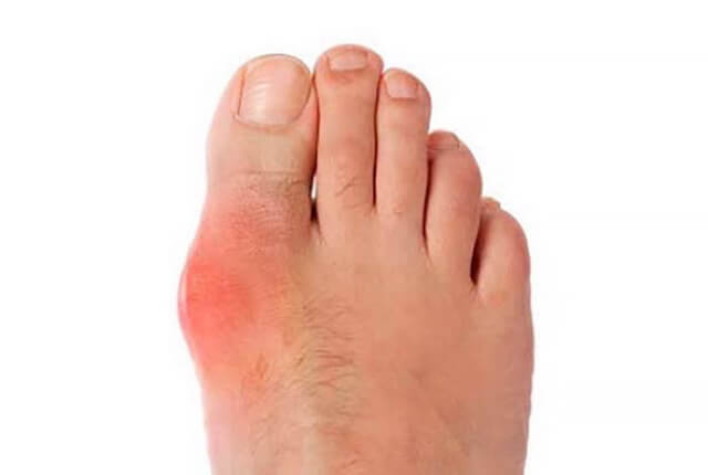 母趾基部の関節（MTP関節）